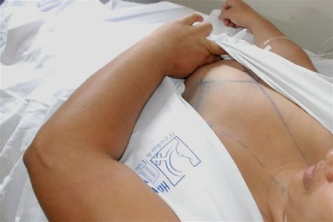 Interessados na cirurgia de gigantomastia devem preencher pré-requisitos