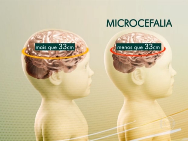 Ministério da Saúde atualiza números de microcefalia relacionados ao Zika