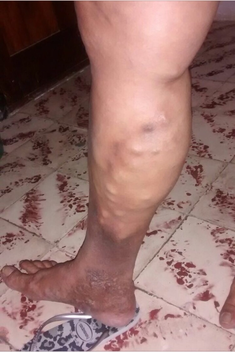 Varizes é a doença vascular mais comum em Feira