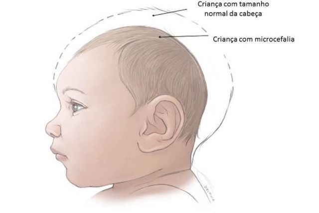 Com 30 novos, casos de microcefalia chegam a 1.581