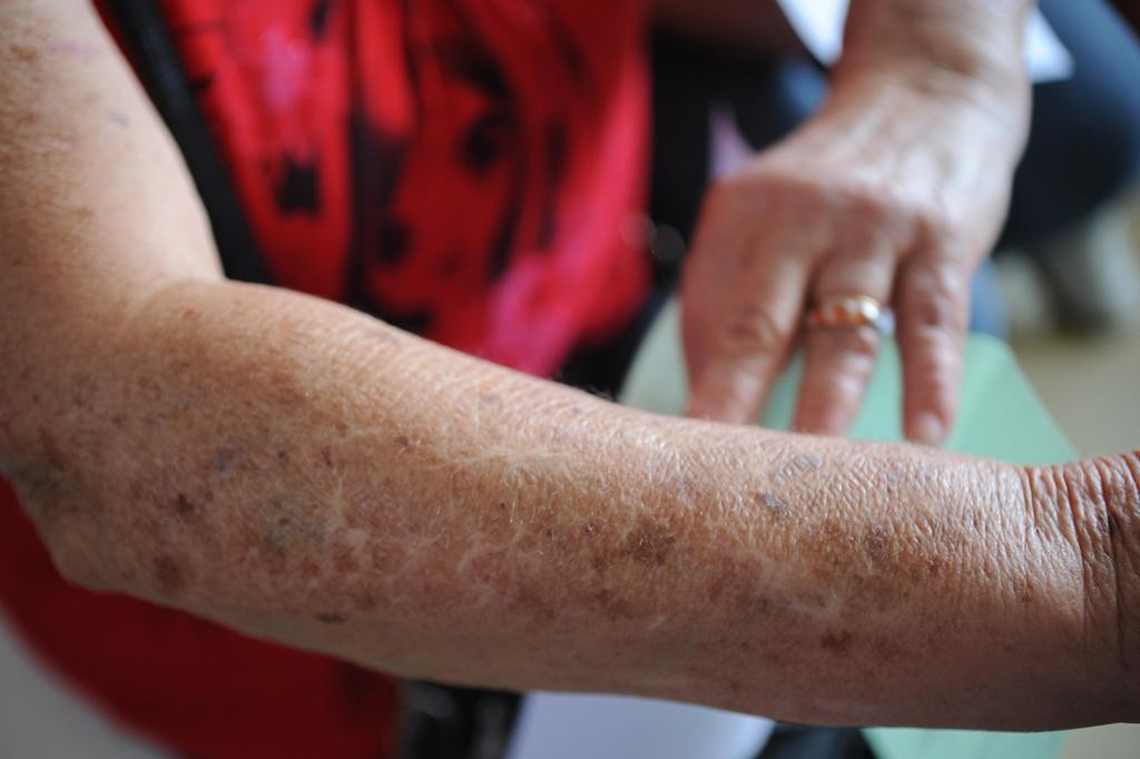 Mutirão oferece atendimento contra câncer de pele em Feira e mais 5 cidades