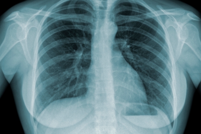 Ministério da Saúde lança Plano Nacional pelo Fim da Tuberculose