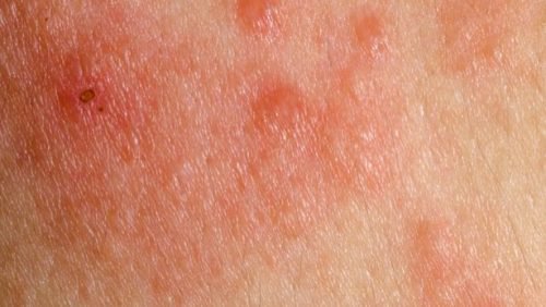 Autoexame e fotoproteção são essenciais para prevenção do câncer de pele,  tumor de maior incidência no Brasil e no mundo