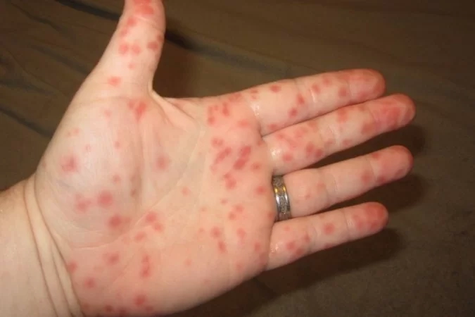 Surto infeccioso de gripe do tomate é registrado na Índia